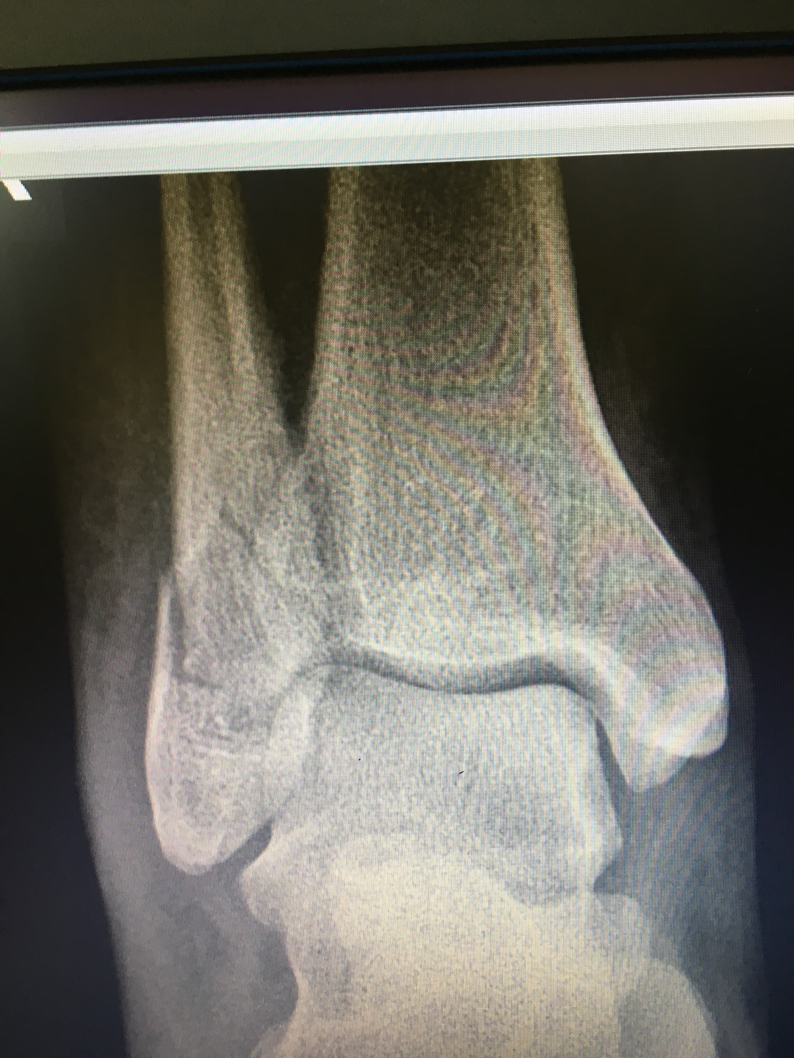 fibula